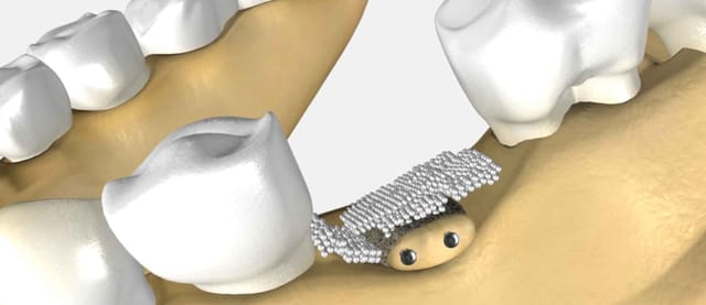 Bone Grafting