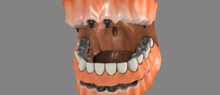 Full Arch Dental Implants