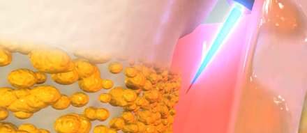 Non-Surgical Laser Therapy