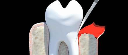 Periodontal Flap Surgery